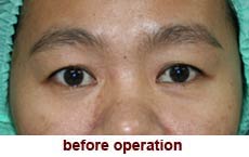 plastic-surgery-blepharoplasty